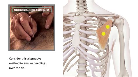 pectoralis minor pain near armpit